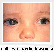 child-with-retinoblastoma1